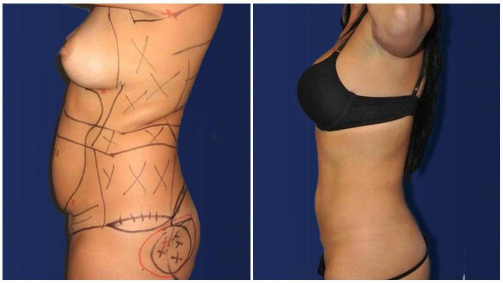 Fat Transfer of a Sacramento Liposuction Specialty Clinic Female Patient - (30 years)